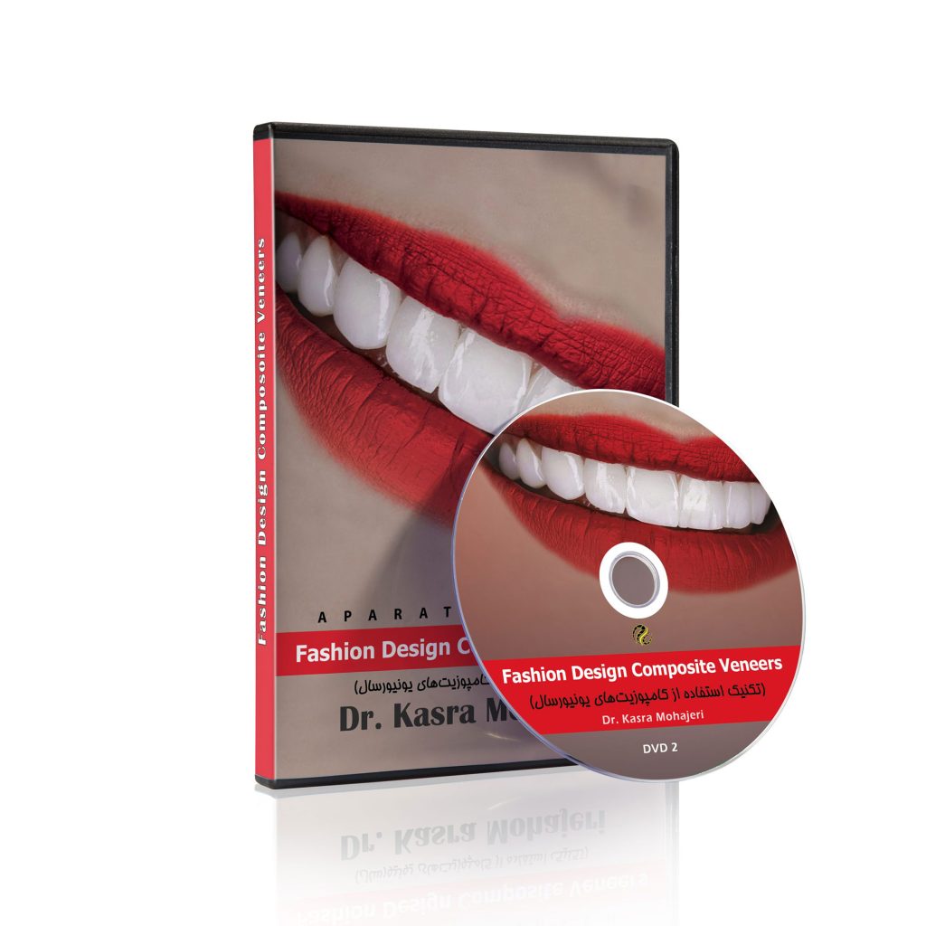 Fashion Design Composite Veneers (تکنیک استفاده از کامپوزیت‌های یونیورسال)